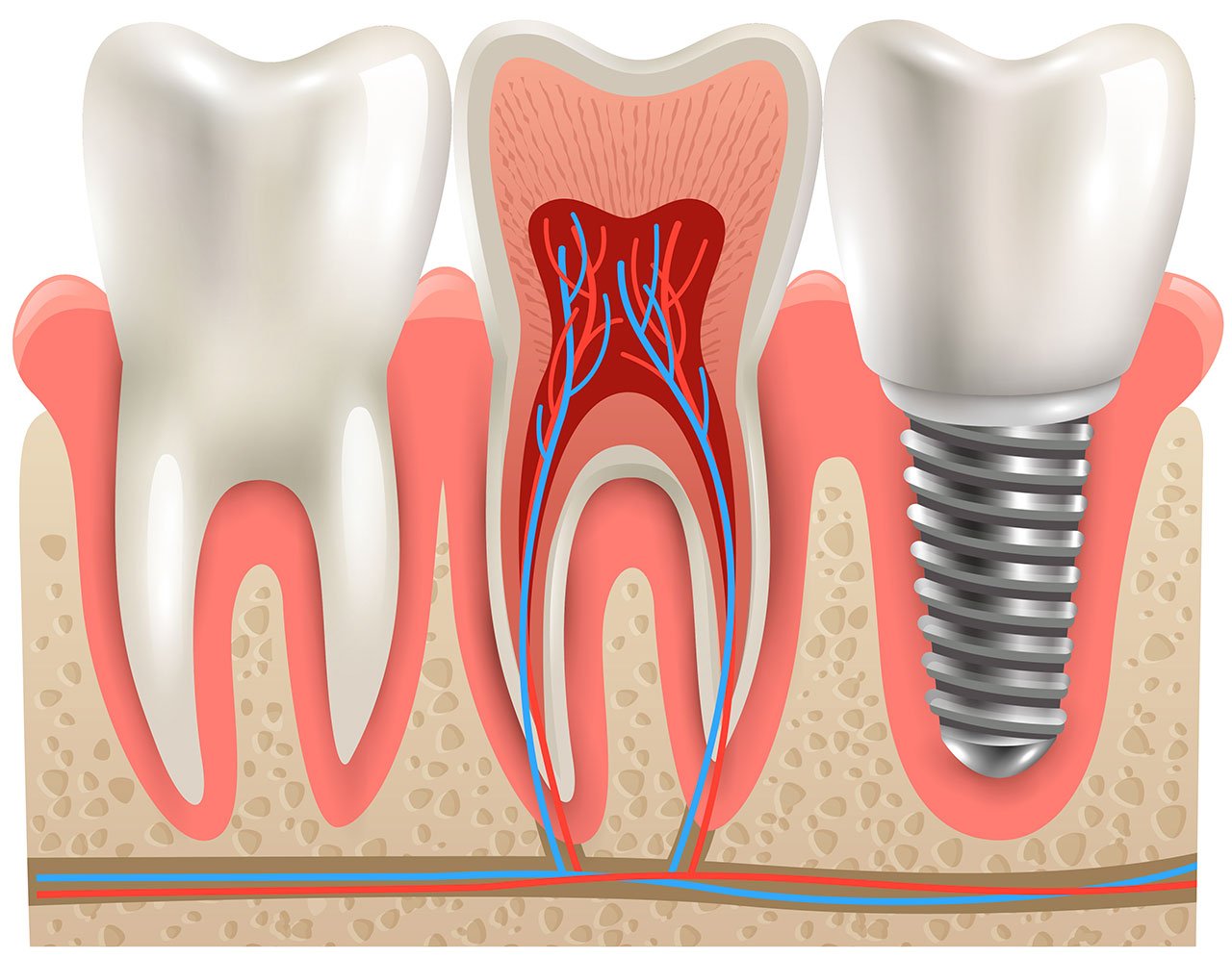 Como funcionam os Implantes Dentários